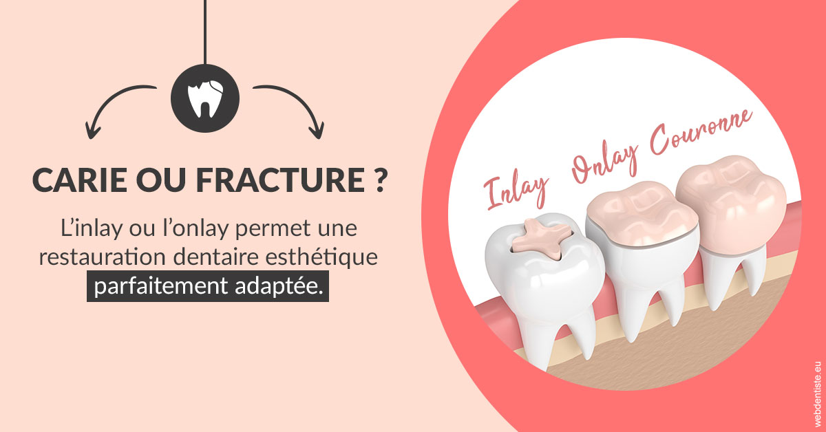 https://dr-gerbay-triollier-caroline.chirurgiens-dentistes.fr/T2 2023 - Carie ou fracture 2