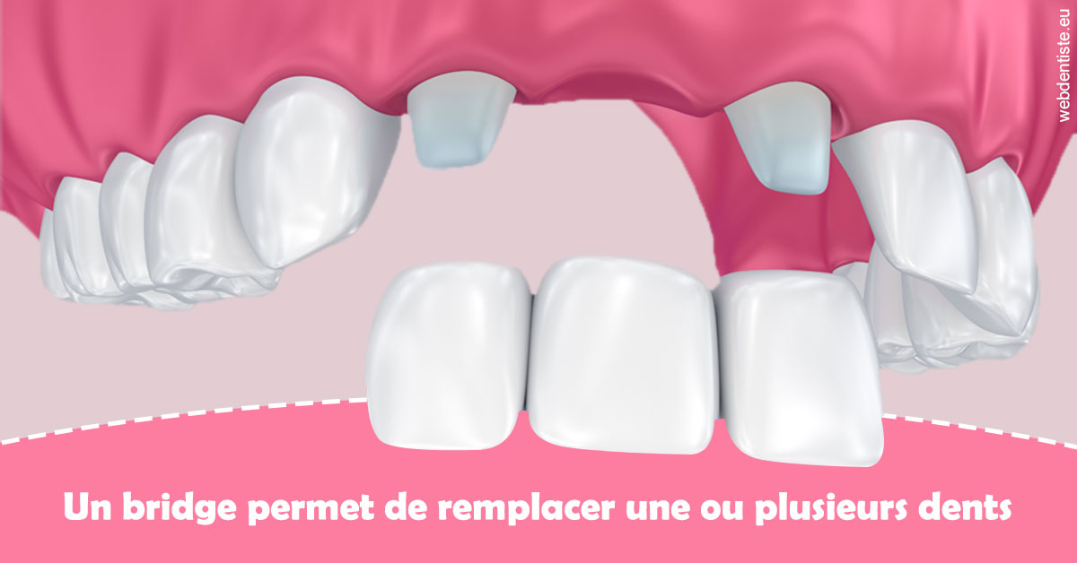 https://dr-gerbay-triollier-caroline.chirurgiens-dentistes.fr/Bridge remplacer dents 2