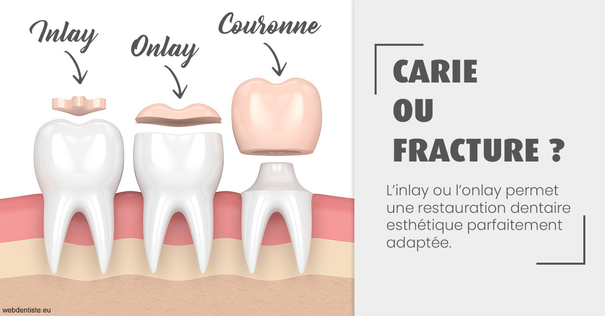 https://dr-gerbay-triollier-caroline.chirurgiens-dentistes.fr/T2 2023 - Carie ou fracture 1